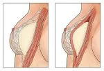 Sau nâng ngực bao lâu thì mềm? Gặp bác sĩ ngay khi có dấu hiệu này