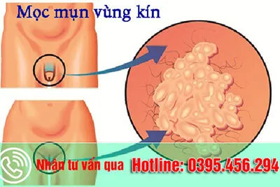 Nổi mụn thịt ở vùng kín nữ giới có thể là bệnh gì? Nguy hiểm không?