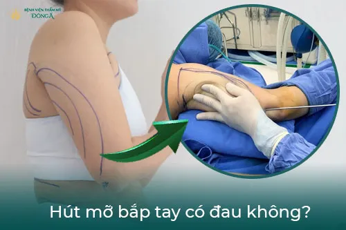 Hút mỡ bắp tay với SlimLipo Vaser - không đau, an toàn, hiệu quả