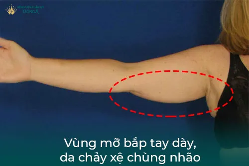 Vùng mỡ bắp tay dày, da chả xệ xuống