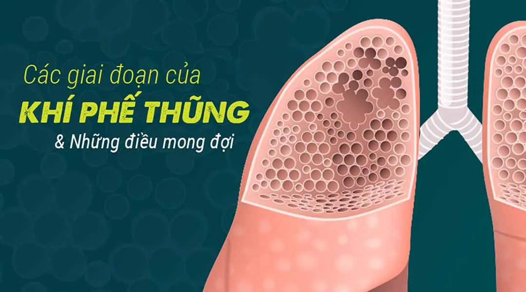 Các giai đoạn của khí phế thũng và những điều mong đợi