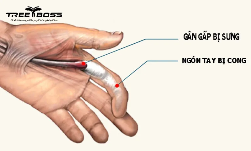 cách trị nhức mỏi tay chân tại nhà