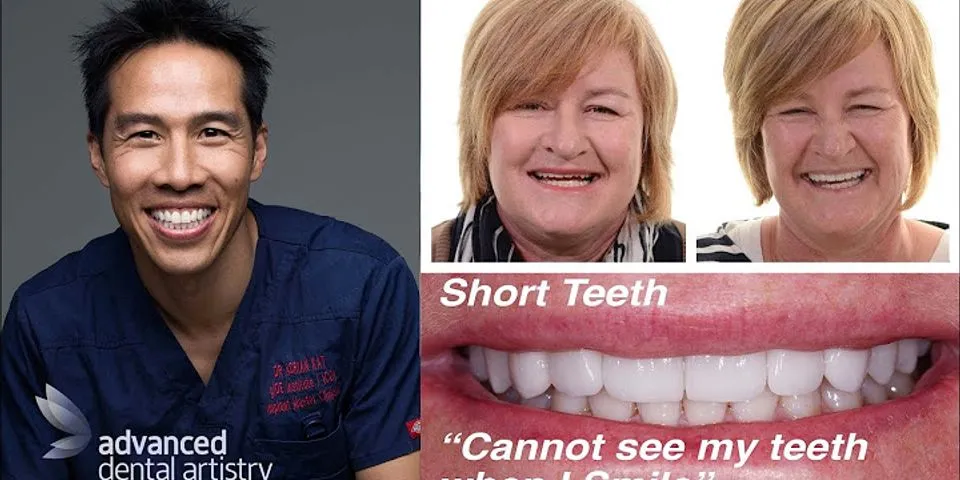short teeth là gì - Nghĩa của từ short teeth